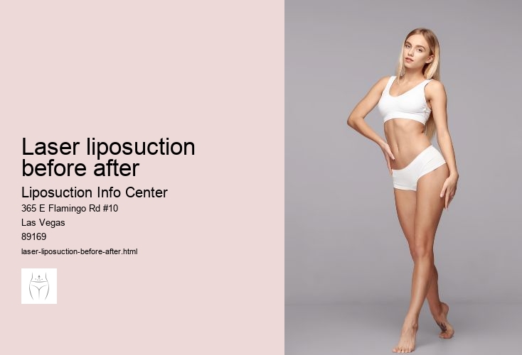 laser liposuction before after