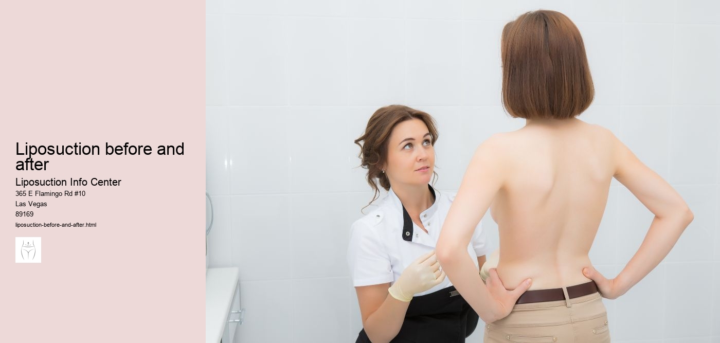 liposuction before and after